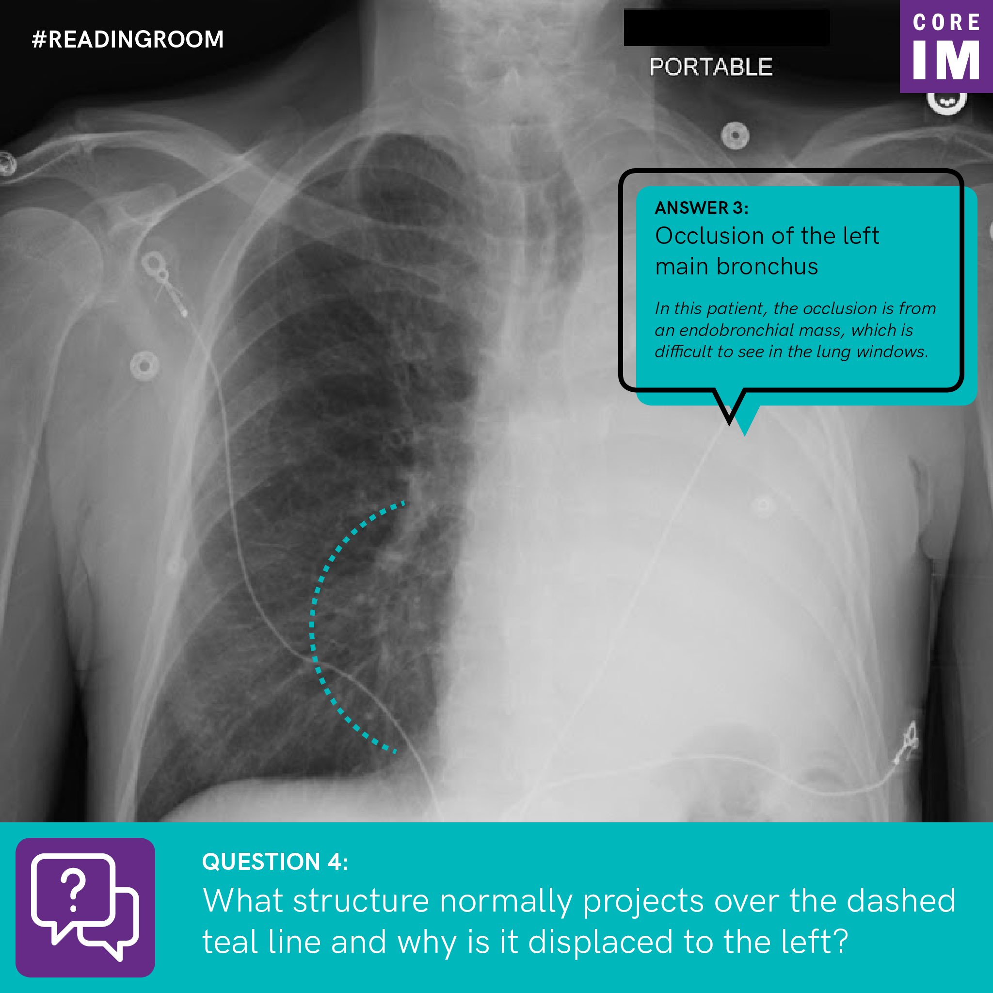 Core Imさんはtwitterを使っています The Answer A L Main Obstruction It Gives Us A Likely Etiology For The Hemithorax Opacification But What S Going On With That Teal Line On The Left Side Of