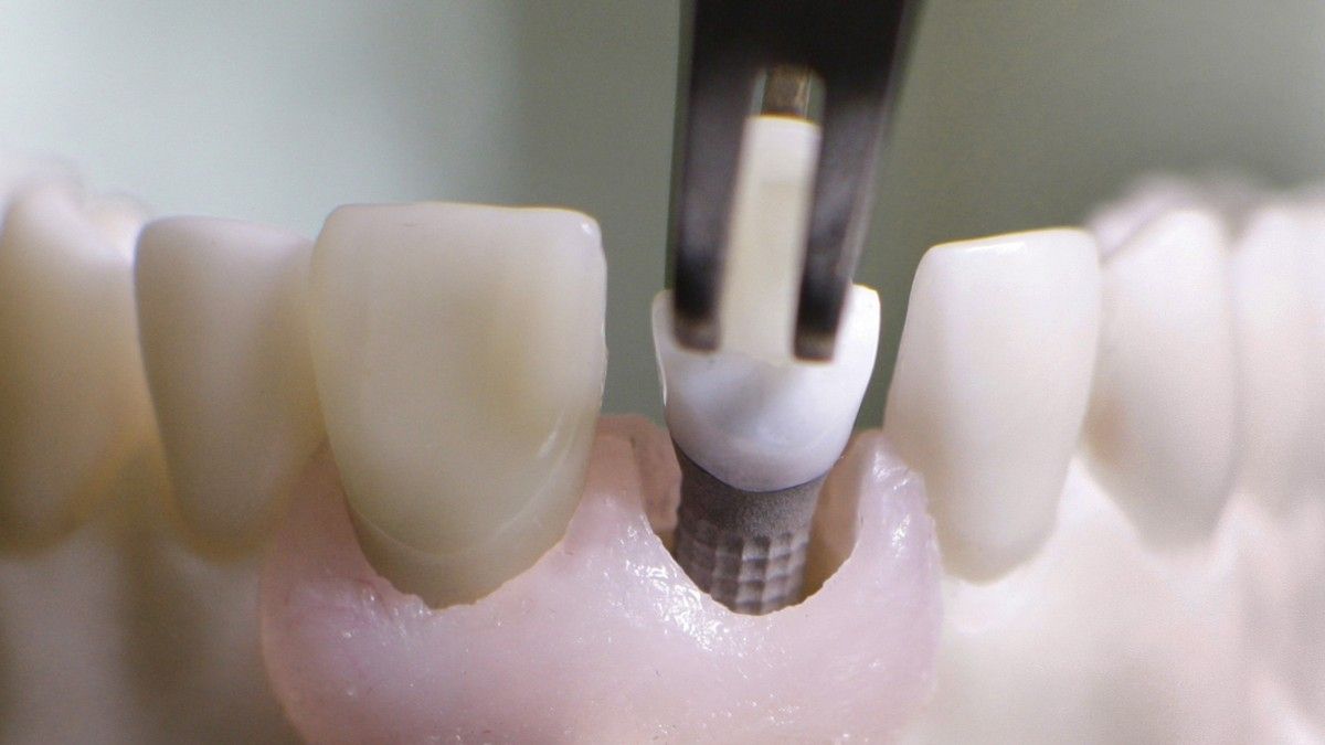 ProfDhomPartner's tweet image. Ein Zahnimplantat bringt Linderung und lässt das Gebiss besser aussehen. Längst ist der Eingriff wissenschaftlich anerkannt. Doch ob der künstliche Zahn hält, hängt vom Patienten ab.

buff.ly/3adSpHr