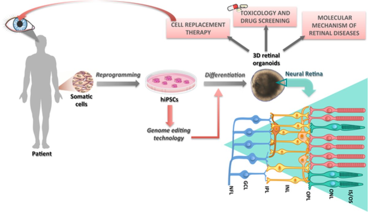 StemCellsJournl's tweet photo. Deciphering retinal diseases through the generation of three dimensional stem cell‐derived organoids
#ConciseReview #organoids #ipsc #DiseaseModeling #RetinitisPigmentosa #Retinal https://t.co/ON6Czez9aK https://t.co/zO1TUpCTVO