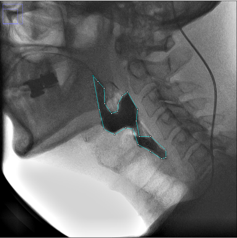 JamesCurtisSLP's tweet photo. If you perform VFSS/MBS and are seeking an easy, objective way to measure of "swallowing efficiency" - then I have the tool just for you! See below! (1/4) https://t.co/SkLgfqfmtJ