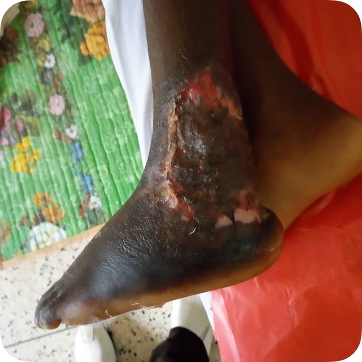 IMOutreach's tweet photo. After a month in the hospital, Sunday is preparing for discharge!

After clearing the infection with antibiotics and debridement, it was possible to proceed to skin grafting.

And it looks great with no evidence of residual infection! https://t.co/3IOudPDFXf