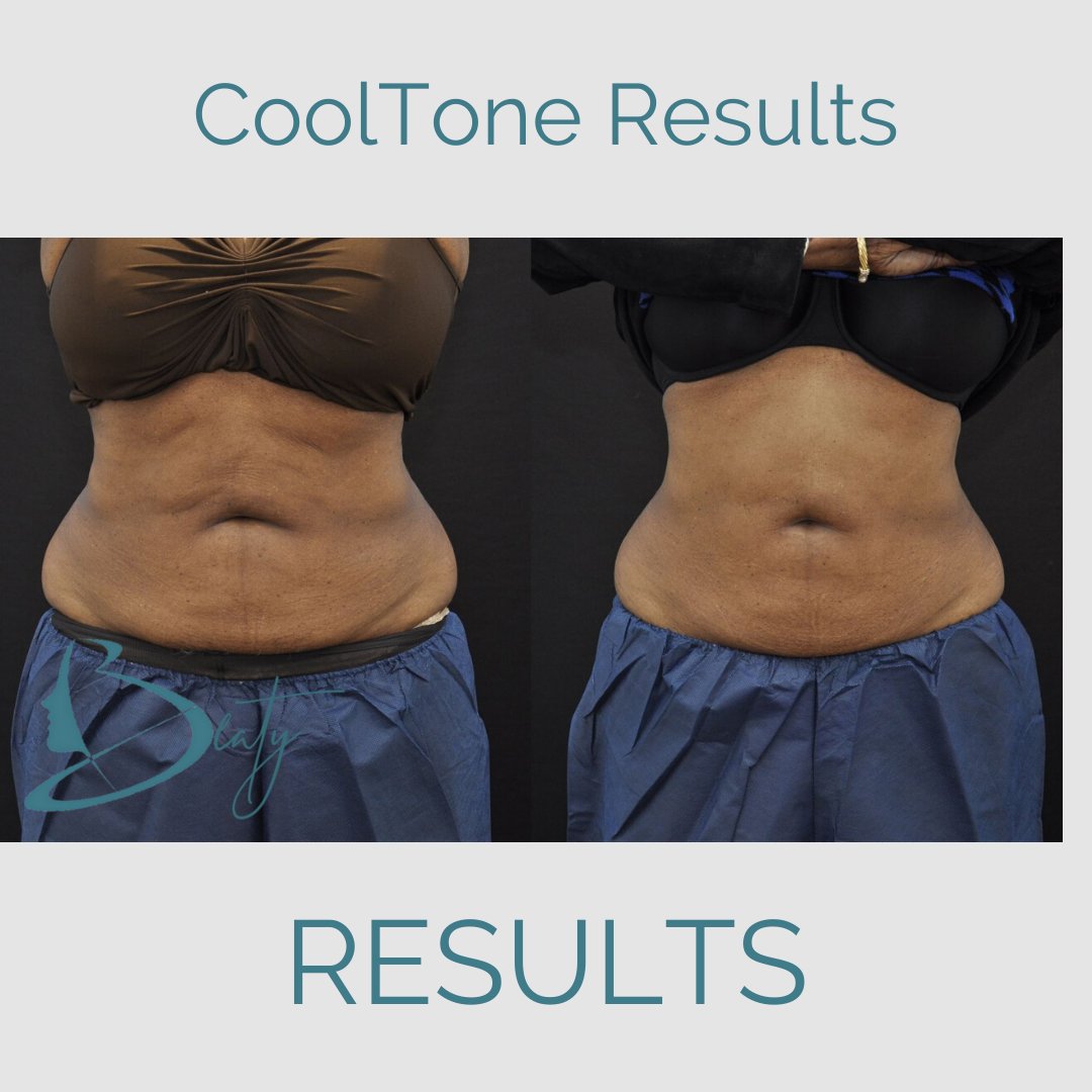 This is a TWO week before and after result with only 4 sessions of CoolTone to her abdomen.  

#gettonedatlanta #cooltoneatlanta #toneyourcorefast #happypatient #beforeandaftercooltone