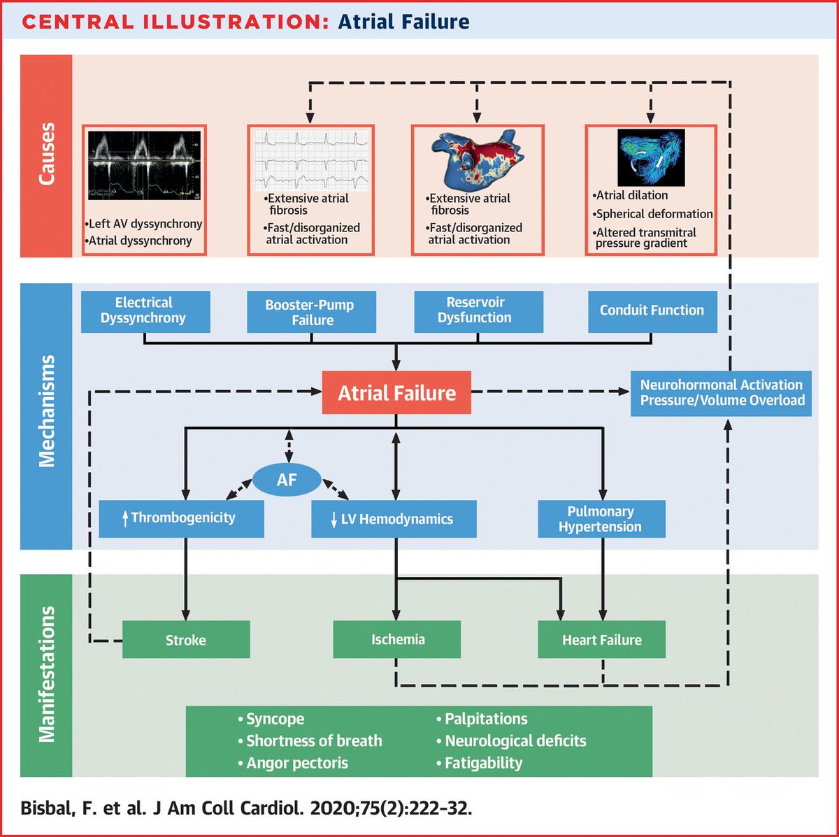 JACC Journals (@jaccjournals) on Twitter photo In this #JACC Review Topic, Drs. <a href="/bisbal_EP/">Felipe Bisbal</a>, <a href="/adribaran/">Adrian Baranchuk MD FACC FRCPC FCCS FSIAC</a> et al. propose the term "atrial failure" as an independent, clinically relevant entity beyond #Afib and #HeartFailure with a diversity of etiologies, mechanisms, and manifestations. bit.ly/30itSMW In this #JACC Review Topic, Drs. <a href="/bisbal_EP/">Felipe Bisbal</a>, <a href="/adribaran/">Adrian Baranchuk MD FACC FRCPC FCCS FSIAC</a> et al. propose the term "atrial failure" as an independent, clinically relevant entity beyond #Afib and #HeartFailure with a diversity of etiologies, mechanisms, and manifestations. bit.ly/30itSMW