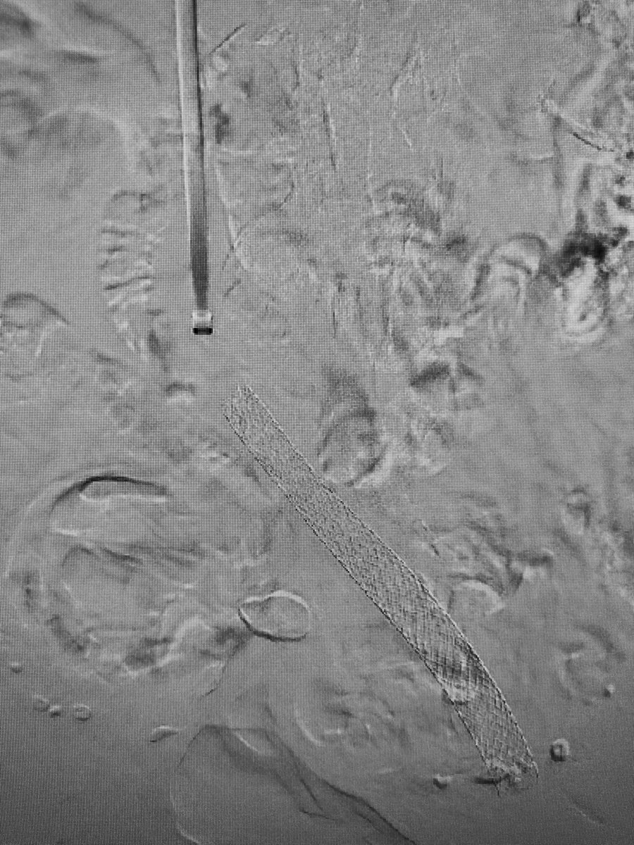 Pt w/acute L leg pain &amp; swelling, extensive #DVT. Tx #Thrombolysis &amp; #mechanicalthrombectomy, venogram shows external compression #MayThurner -stent placed in L iliac vein. 1 month follow up patient has complete resolution of symptoms #irad #withoutascalpel