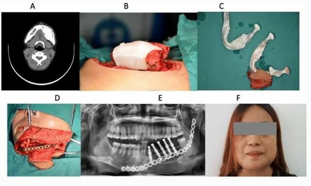 3dheals's tweet image. Head &amp;amp; neck tumors: 3D printing &amp;amp; virtual reality aid in surgical planning #3dprinting #robotics #medicalmodels #VirtualReality #surgicalplanning #technology #computeraidedsurgery #tumor #healthcare #JoinTheTribe buff.ly/2MQgie9 ift.tt/3agLo8Y