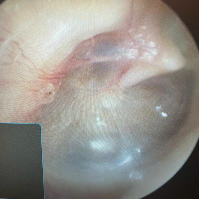 DrEricCarniol's tweet photo. When your doctor looks in your ear, this is what he/she sees. You can see the drum itself, the malleus (first ear bone), and the chords tympani (the nerve that gives you taste). We see a lot in there! This picture was taken with our excellent sinus equipment that allows us t… https://t.co/wmdWSs9V6d