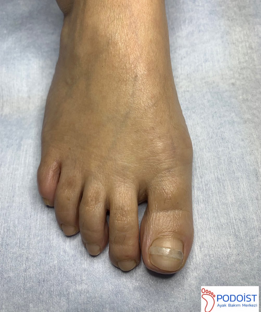 Batık tırnak tedavisi #podoloji #podolog #podoist bilgi için 0530 181 6038 veya podoist.com <a href="/GalatasaraySK/">Galatasaray SK</a> <a href="/podoist/">Podoist Ayak Bakım Merkezi</a> <a href="/Fenerbahce/">Fenerbahçe SK</a> <a href="/Besiktas/">Beşiktaş JK</a>