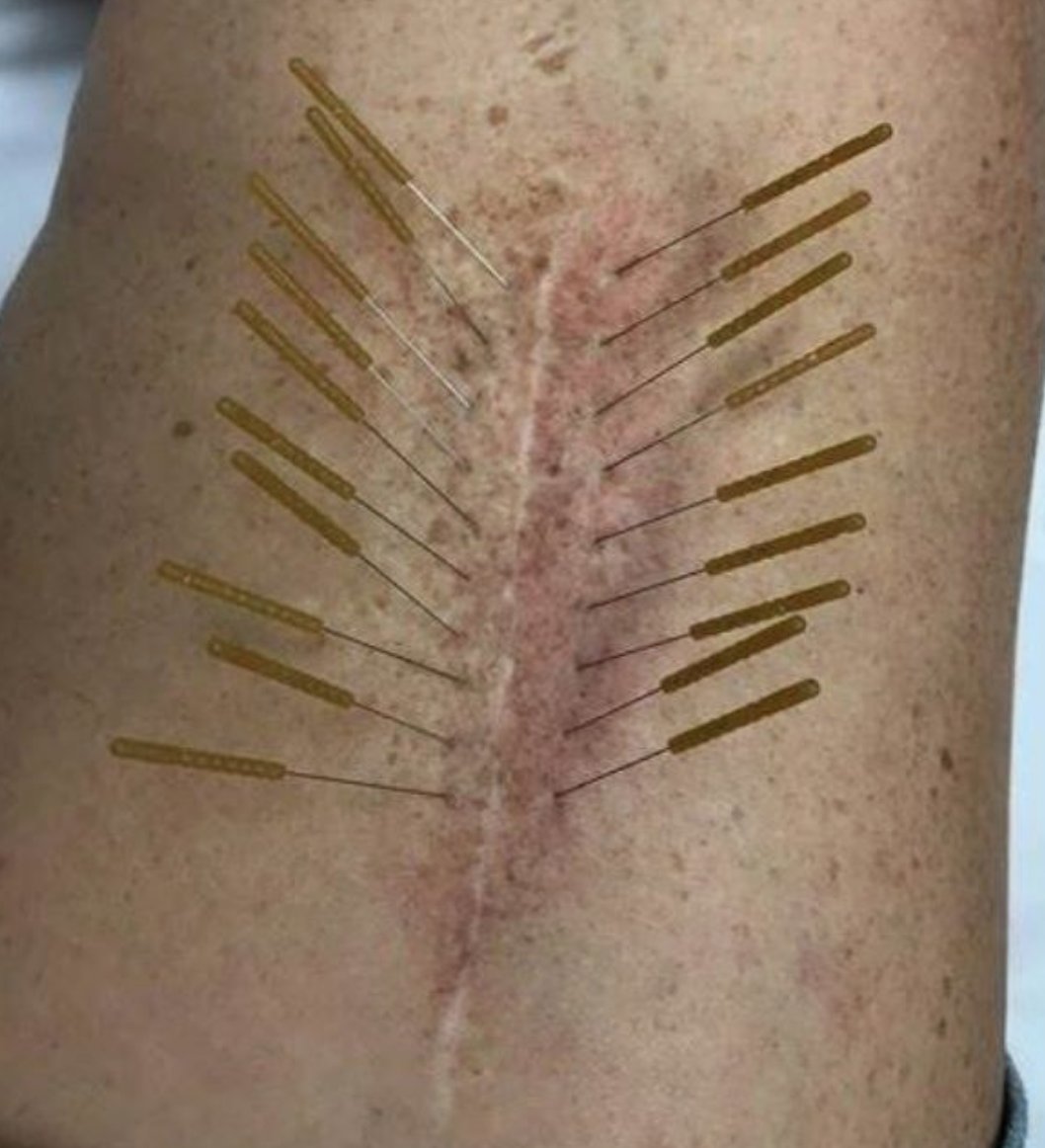 https://iaom-us.com/deep-dry-needling-may-be-more-effective-in-treating-spi...