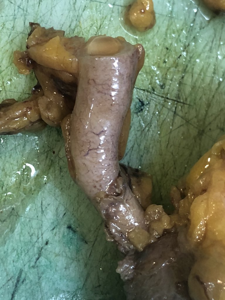 BagcPelin's tweet photo. Dilated appendix  with a mucin balloon in it 🎈final dx was a little bit different than expected. Gross dx(s) are appreciated 🤗 #appendix https://t.co/kNtMH60msu