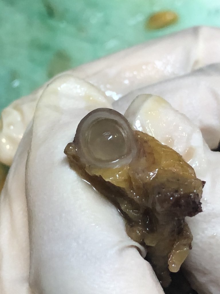 BagcPelin's tweet photo. Dilated appendix  with a mucin balloon in it 🎈final dx was a little bit different than expected. Gross dx(s) are appreciated 🤗 #appendix https://t.co/kNtMH60msu
