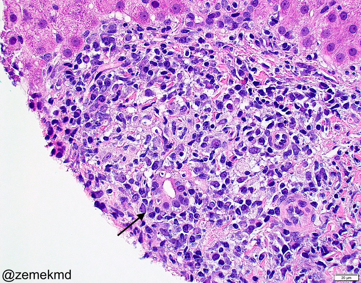 zemekmd's tweet photo. Middle aged F, mildly elevated AST/ALT with high alkphos and GGT, high titer positive AMA. Liver biopsy shows nodular portal based lymphoplasmacytic infiltrate, bile ductular injury, rare epithelioid granulomas. Dx: Primary biliary cholangitis. #GIpath #Liverpath #Textbookcase https://t.co/zTbv2N6Qk8