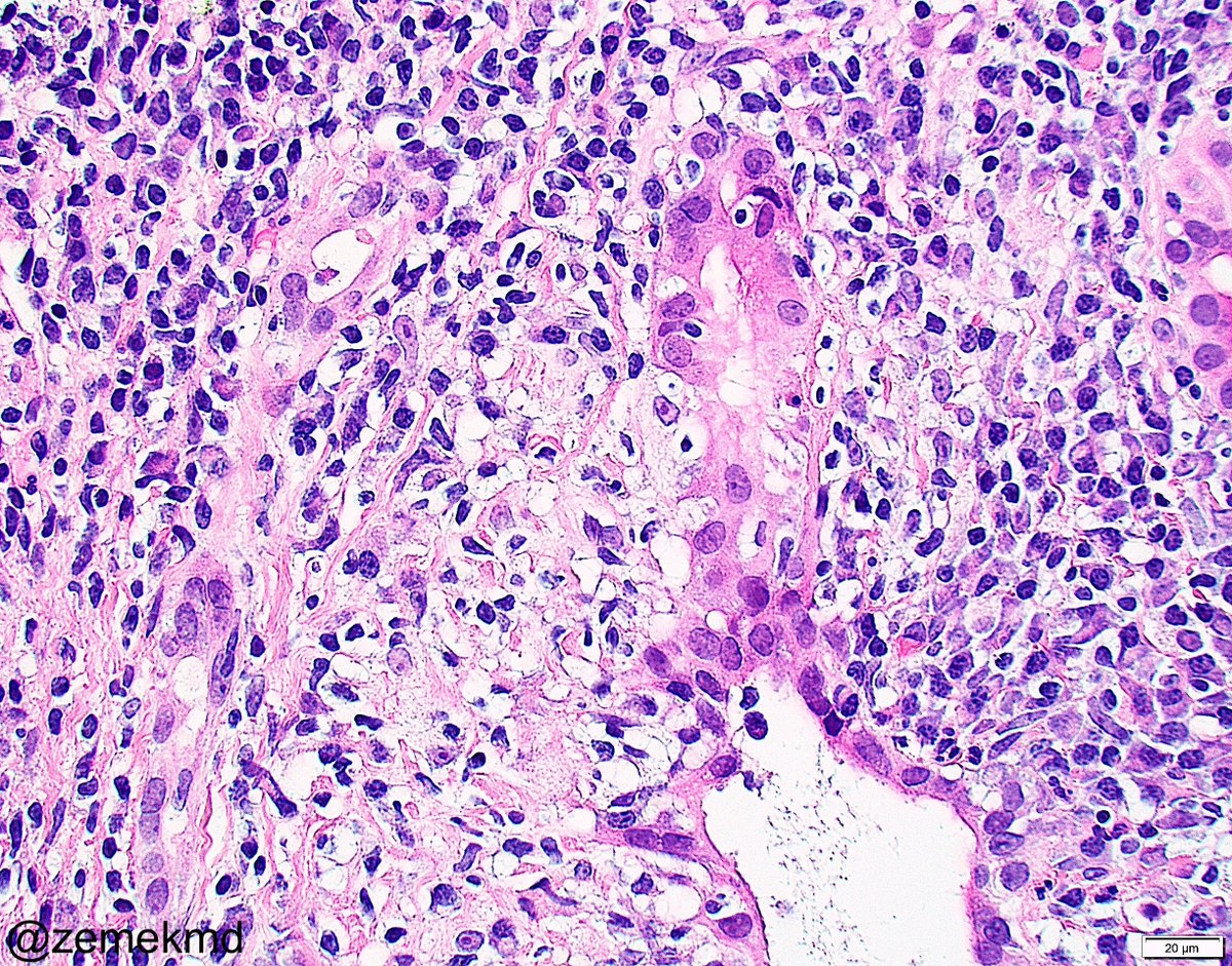 zemekmd's tweet photo. Middle aged F, mildly elevated AST/ALT with high alkphos and GGT, high titer positive AMA. Liver biopsy shows nodular portal based lymphoplasmacytic infiltrate, bile ductular injury, rare epithelioid granulomas. Dx: Primary biliary cholangitis. #GIpath #Liverpath #Textbookcase https://t.co/zTbv2N6Qk8