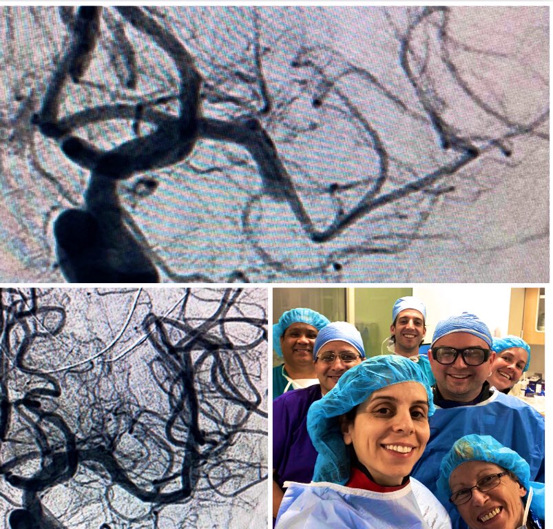 StavTjoumakaris's tweet photo. TICI 0-3 with one of the first in the U.S. Large Bore Catheter @Cerenovus in an 80 yo patient. Excellent distal trackability with strong proximal support. So proud of this amazing team at @FarberNeuro @JeffersonUniv! https://t.co/BlfUdHF0gx