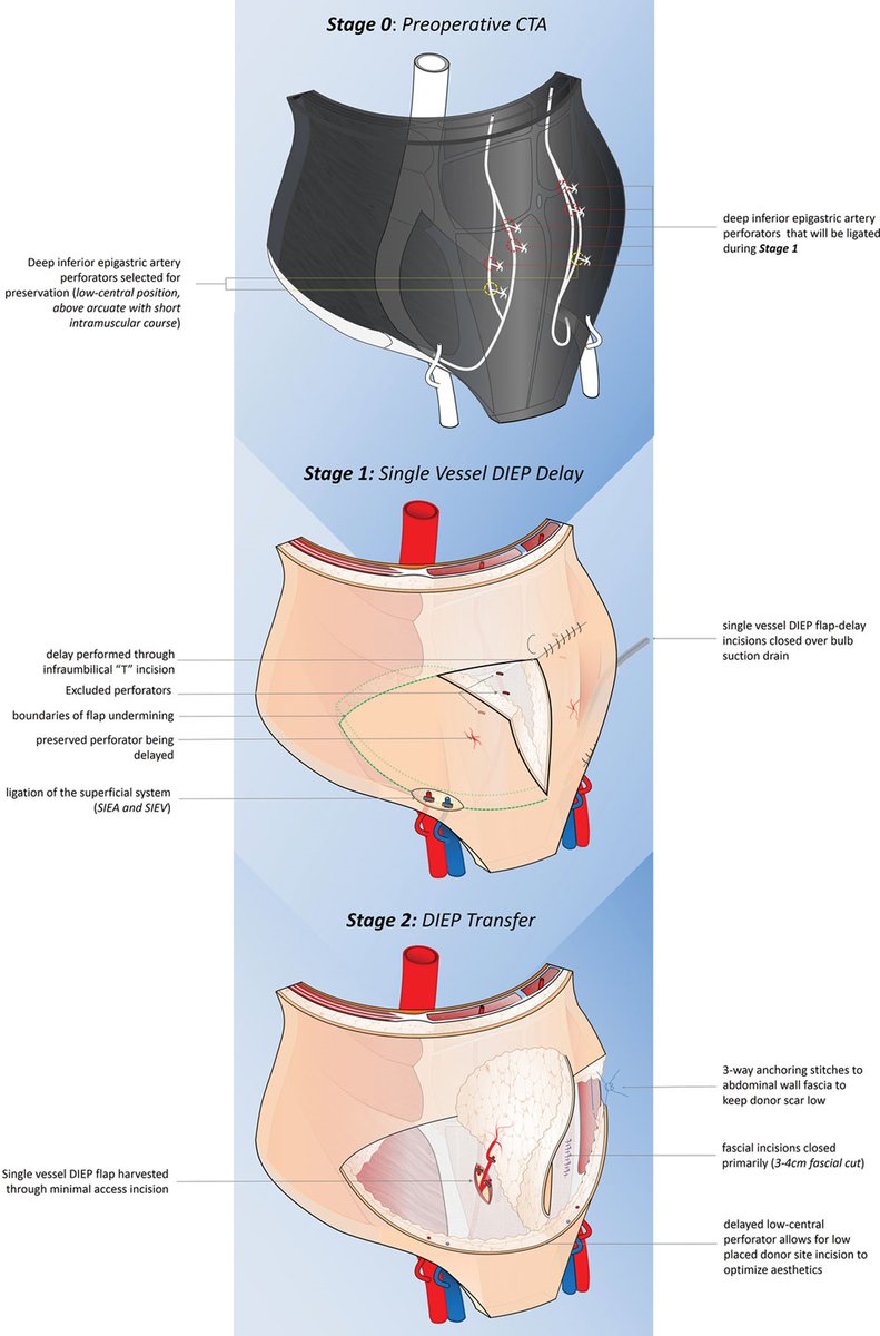 PennPlasticSurg's tweet photo. Congratulations to @sameershakirmd (PGY5), @geoffkozak08_md (former Research Fellow), Dr. Kanchwala et al. on their @prsjournal paper on 2-stage technique of DIEP flap #reconstruction using #tissueexpanders! Read the full version here👉👉https://t.co/hqAdDH0axW #plasticsurgery https://t.co/UI7Px15nqs