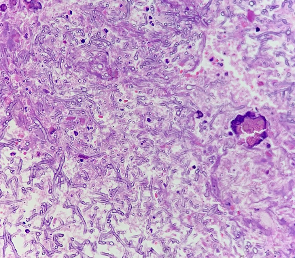 gauriii_23's tweet image. Pulmonary wedge resection for a Cavitatory lesion in Left Upper Lobe #pulmonarypath