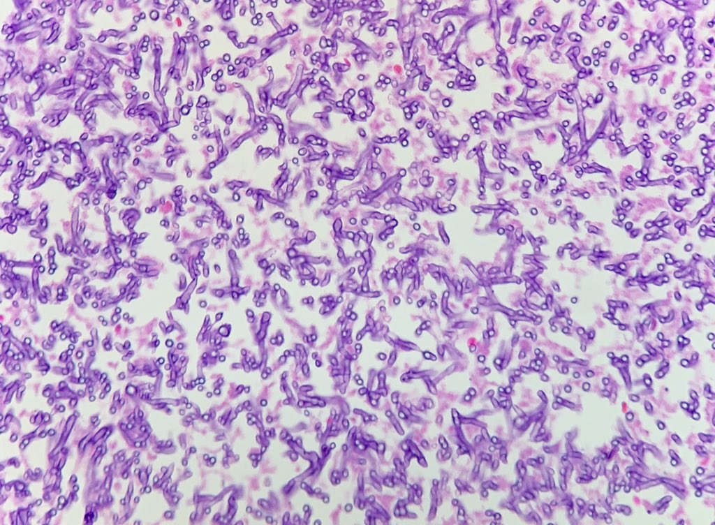 Pulmonary wedge resection for a Cavitatory lesion in Left Upper Lobe #pulmonarypath