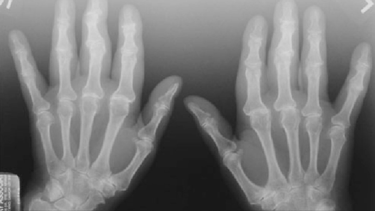 reinmd77's tweet photo. RAre mimic
63yo♀️>40yrs large&amp;small jts pain -inflammatory type
X-ray Atypical destruct changes
Clue FHx vy early/pediatric  OA
Proof mutat COL11A2

Dx adult Stickler syndr III
https://t.co/SQwEJ1Umed https://t.co/VdUaLm7CsK
