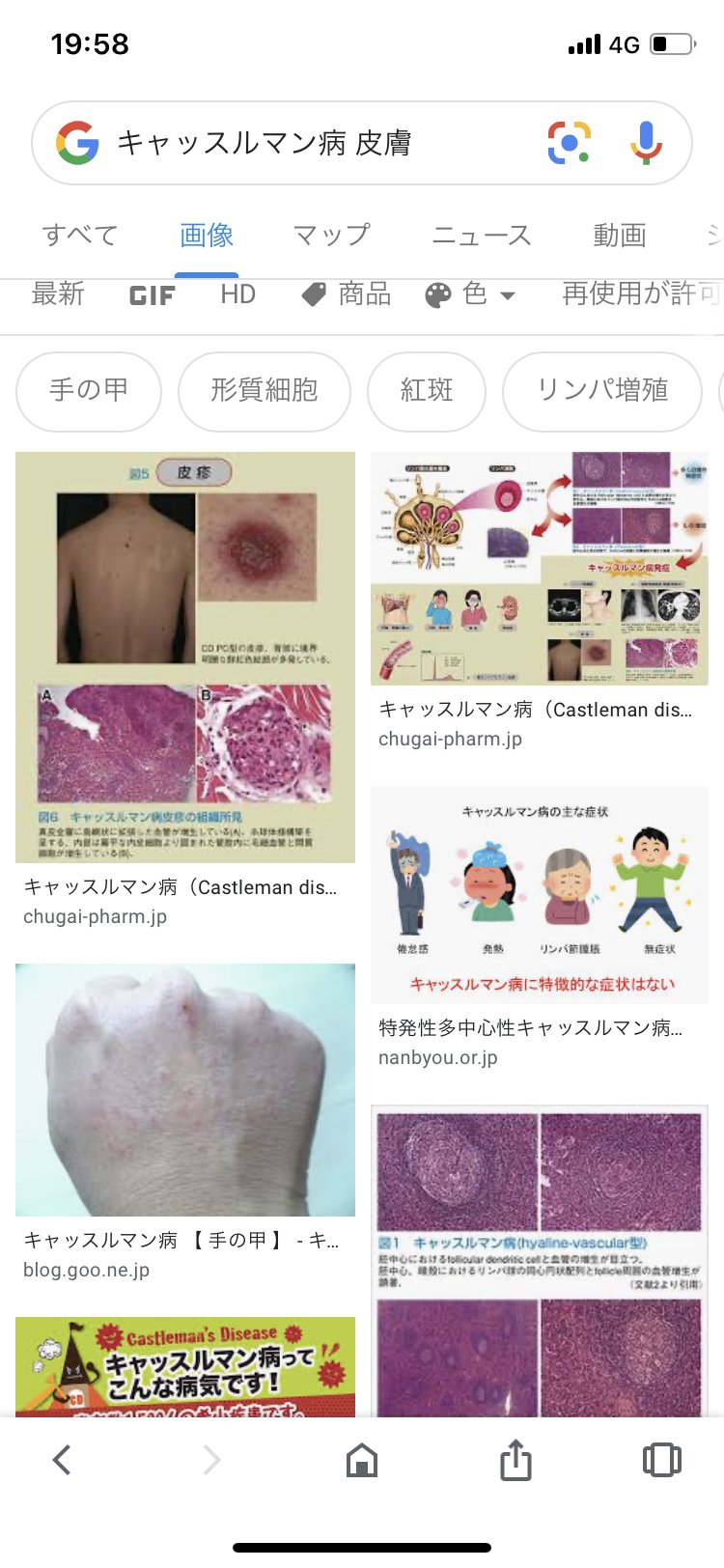 野村俊一 特発性多中心性キャッスルマン病 血液検査 正 小球性の貧血 多クローン性の高ガンマグロブリン血症高crp血症がみられる 多くの症例で血清アルカリホスファターゼ高値を示すが Ldhは正常 低値のことが多い 高インター