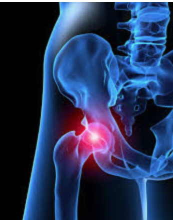 bennwachukwumd's tweet photo. Ever wondered how a #hiplabrum repair is treated? Read about non-surgical versus surgical options here: https://t.co/Q05iFQZhfi #orthotwitter https://t.co/8I7nAbTzPp