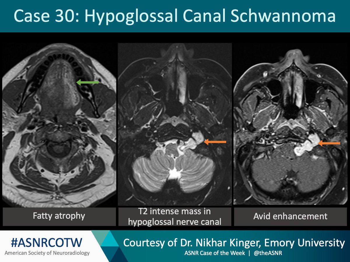 The American Society of Neuroradiology tweet media