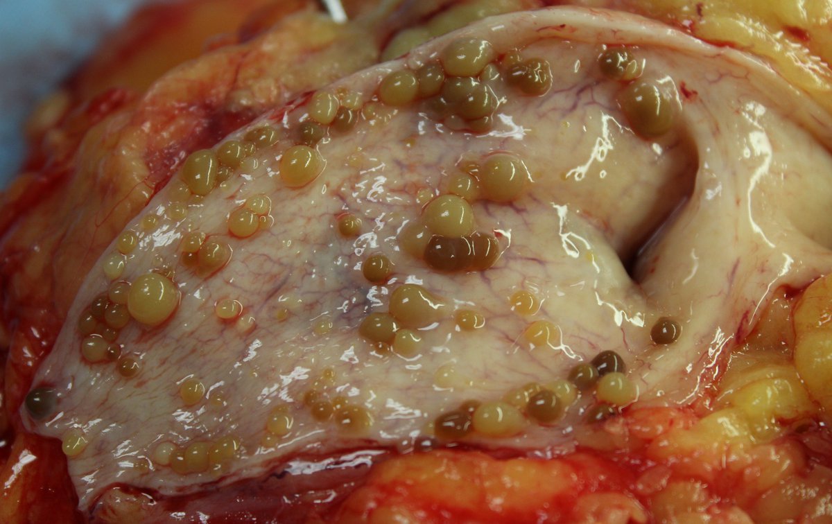 UTSW_GUPath's tweet photo. Upper ureter from a nephroureterectomy specimen!
Any thoughts? #GUpath https://t.co/d7nqkKWeoi
