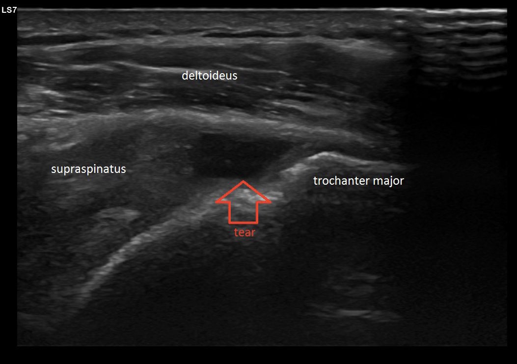 Supraspinatus partial rupture #supraspinatustear #mskus #pocus #s7r3 #rotatorcufftear #gehealthcare