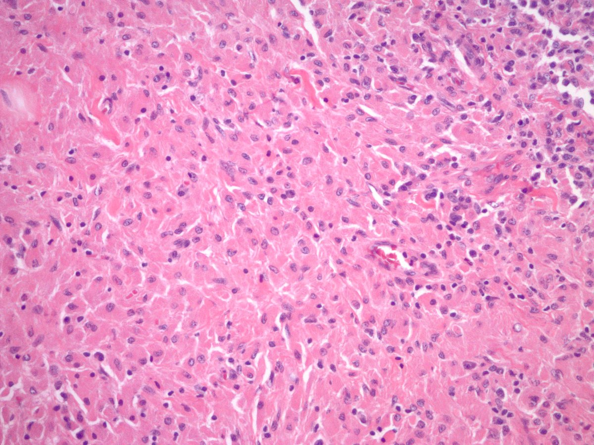 jake_bledsoe's tweet image. CRYSTAL STORING HISTIOCYTOSIS in a lymph node. Macrophages laden with eosinophilic subtle crystalline material. CD68 and kappa IHC shown. Lambda was negative. #pathology #hemepath #BSTpath