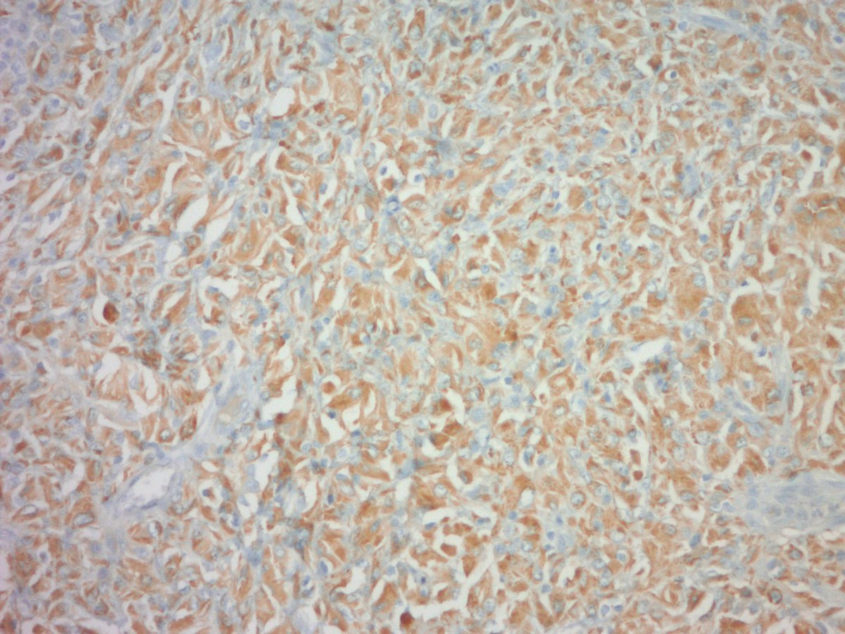 jake_bledsoe's tweet image. CRYSTAL STORING HISTIOCYTOSIS in a lymph node. Macrophages laden with eosinophilic subtle crystalline material. CD68 and kappa IHC shown. Lambda was negative. #pathology #hemepath #BSTpath