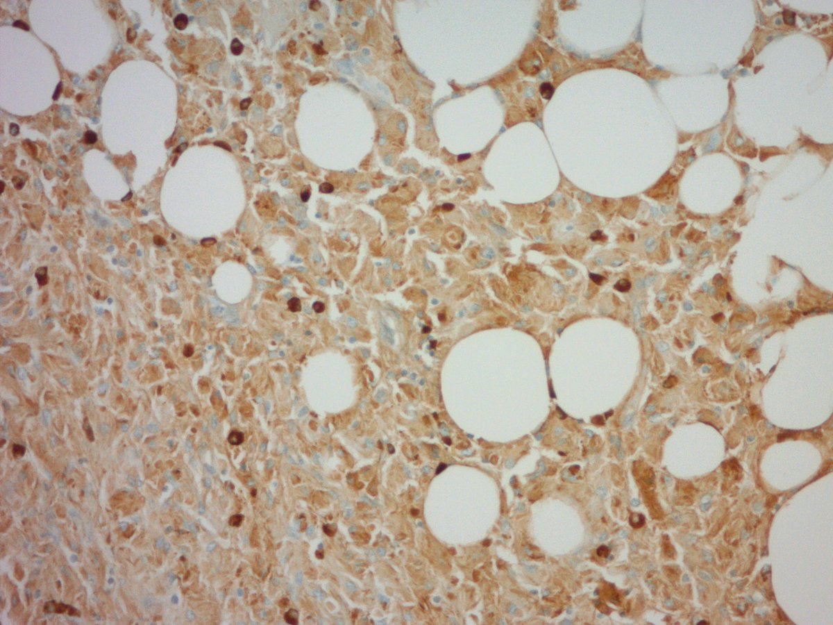 jake_bledsoe's tweet image. CRYSTAL STORING HISTIOCYTOSIS in a lymph node. Macrophages laden with eosinophilic subtle crystalline material. CD68 and kappa IHC shown. Lambda was negative. #pathology #hemepath #BSTpath