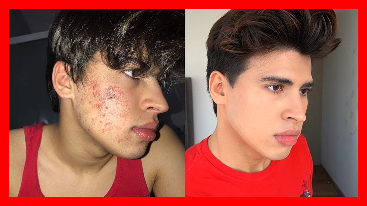 ladivaza's tweet photo. NUEVO VIDEO: 

COMO CURÉ MI ACNÉ
https://t.co/UaXx38gcI7

Dale LIKE, COMENTA Y SUSCRÍBETE.
¿RT para que más gente lo vea? 💫 https://t.co/xFrDluGyGx