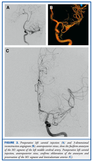 DrBaskaya's tweet photo. Application of #Yaşargil T-Bar #Clip for the #Treatment of #Fusiform M1 #Aneurysm: Case Illustration and #Technical Report
https://t.co/iEfcCBVLYZ
@uw_neurosurgery @UWHealth @uwsmph @NeurosurgeryCNS
#Technique #microsurgery #eCase #Illustration #nsgy #Neurosurgery #Laboratory https://t.co/eMxZj5HPOd