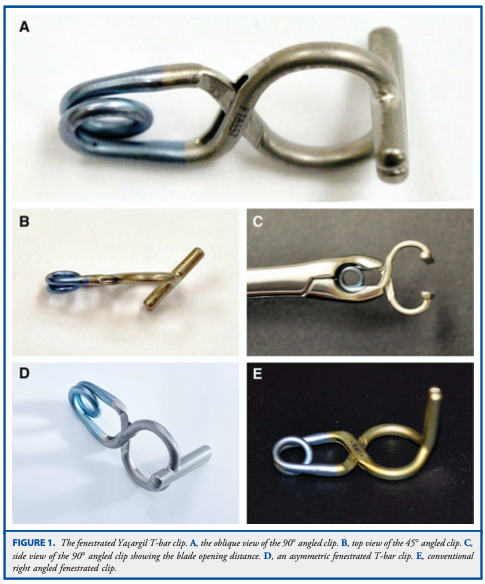DrBaskaya's tweet photo. Application of #Yaşargil T-Bar #Clip for the #Treatment of #Fusiform M1 #Aneurysm: Case Illustration and #Technical Report
https://t.co/iEfcCBVLYZ
@uw_neurosurgery @UWHealth @uwsmph @NeurosurgeryCNS
#Technique #microsurgery #eCase #Illustration #nsgy #Neurosurgery #Laboratory https://t.co/eMxZj5HPOd