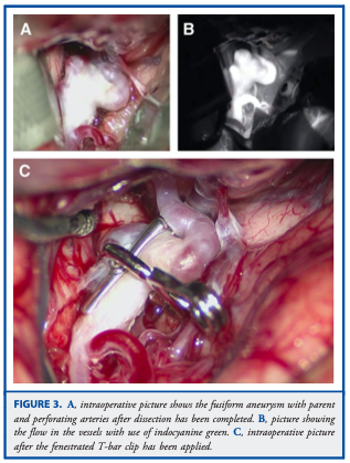 DrBaskaya's tweet photo. Application of #Yaşargil T-Bar #Clip for the #Treatment of #Fusiform M1 #Aneurysm: Case Illustration and #Technical Report
https://t.co/iEfcCBVLYZ
@uw_neurosurgery @UWHealth @uwsmph @NeurosurgeryCNS
#Technique #microsurgery #eCase #Illustration #nsgy #Neurosurgery #Laboratory https://t.co/eMxZj5HPOd