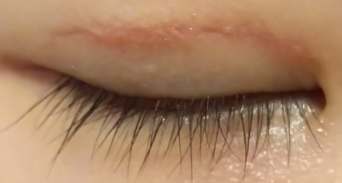 えぬ 眼瞼下垂症手術 右目 修正手術後39日目 左目 術後48日目 軟膏まだあと1本と半分塗り続けるの結構期間長いな なかなかなくならない 笑 なぜか再手術した右瞼の方が感覚がだいぶ戻っていて左瞼はまだまだ鈍い 眼瞼下垂 手術 術後 抜糸