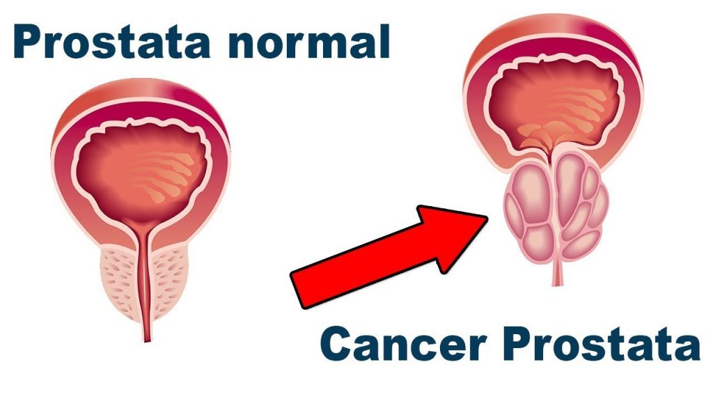 Ya existe la cura del cancer Ya existe la cura del cancer