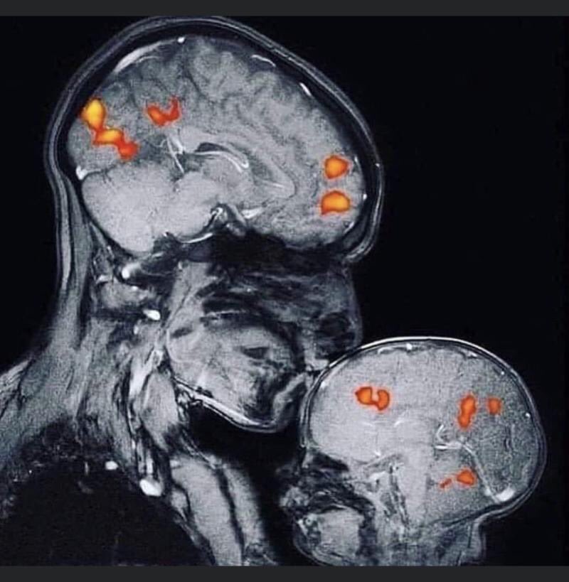 Moederliefde ❤️

Dit is de eerste MRI die hersenactiviteit vastlegt op het moment dat de moeder haar kind kust.

Haar kus veroorzaakt een chemische reactie in de hersenen die het hormoon oxytocine vrijmaakte, wat gevoelens van verbondenheid en liefde creëert.