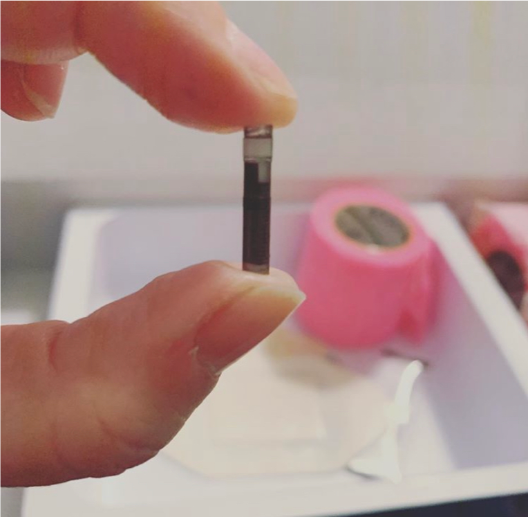 EversenseCGM's tweet photo. Happy #SensorSaturday! Eversense is the first long-term implantable CGM sensor. Thanks for sharing  @i_run_on_curses_and_insulin! 
.
.
“Here is the 4th sensor they took out of my arm. It was replaced with a new one, just like it." https://t.co/aPC1fZOWBG