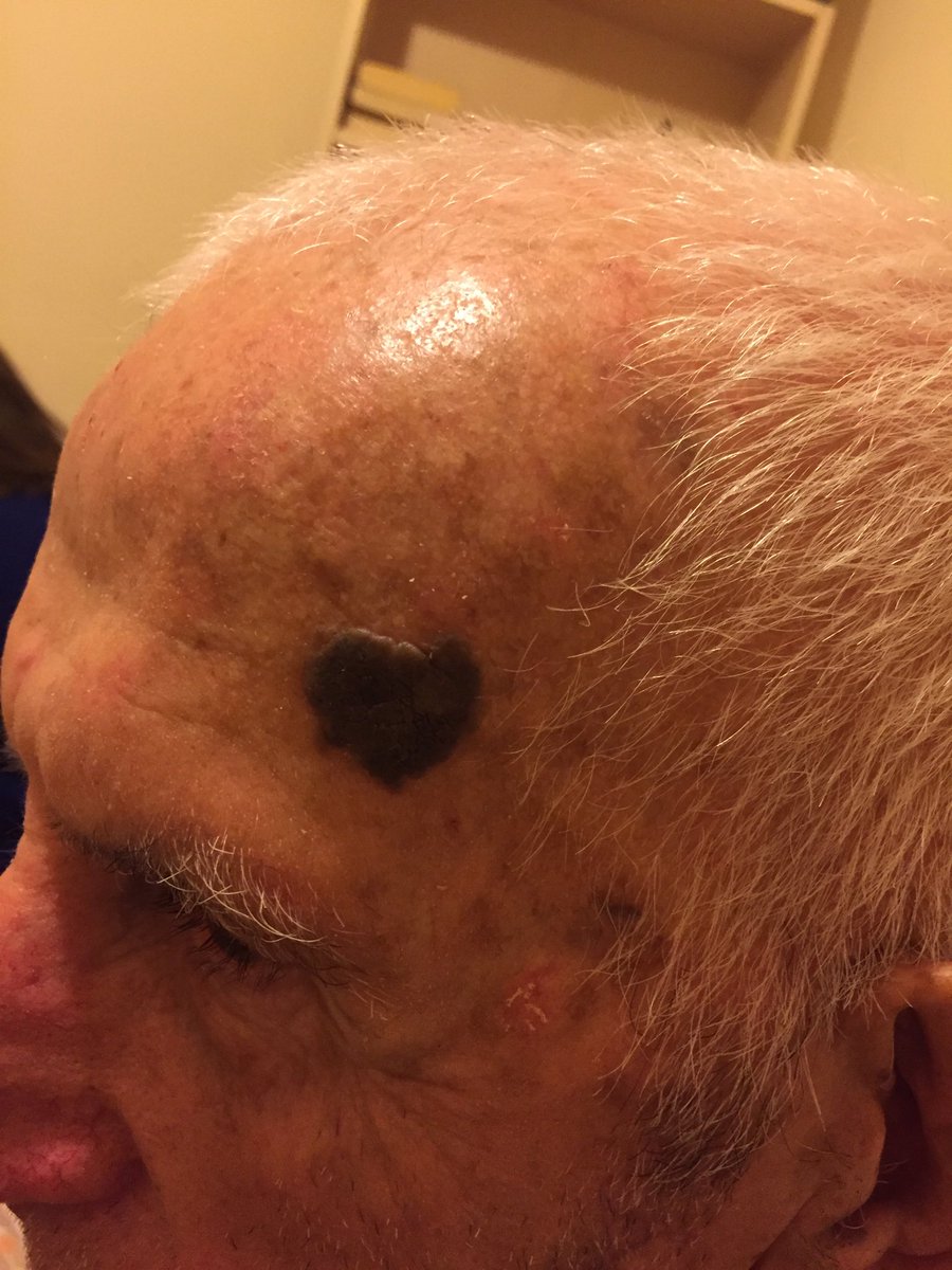 Canım dedemin kafasında kalp şeklinde ben var 🥰🥰
Onu o kadar çok seviyorum kiiii