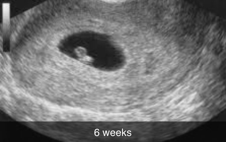 Тянет низ живота на 6 неделе. УЗИ на 6 акушерской неделе. УЗИ 8 недель беременности. Эмбрион на 6 акушерской неделе.