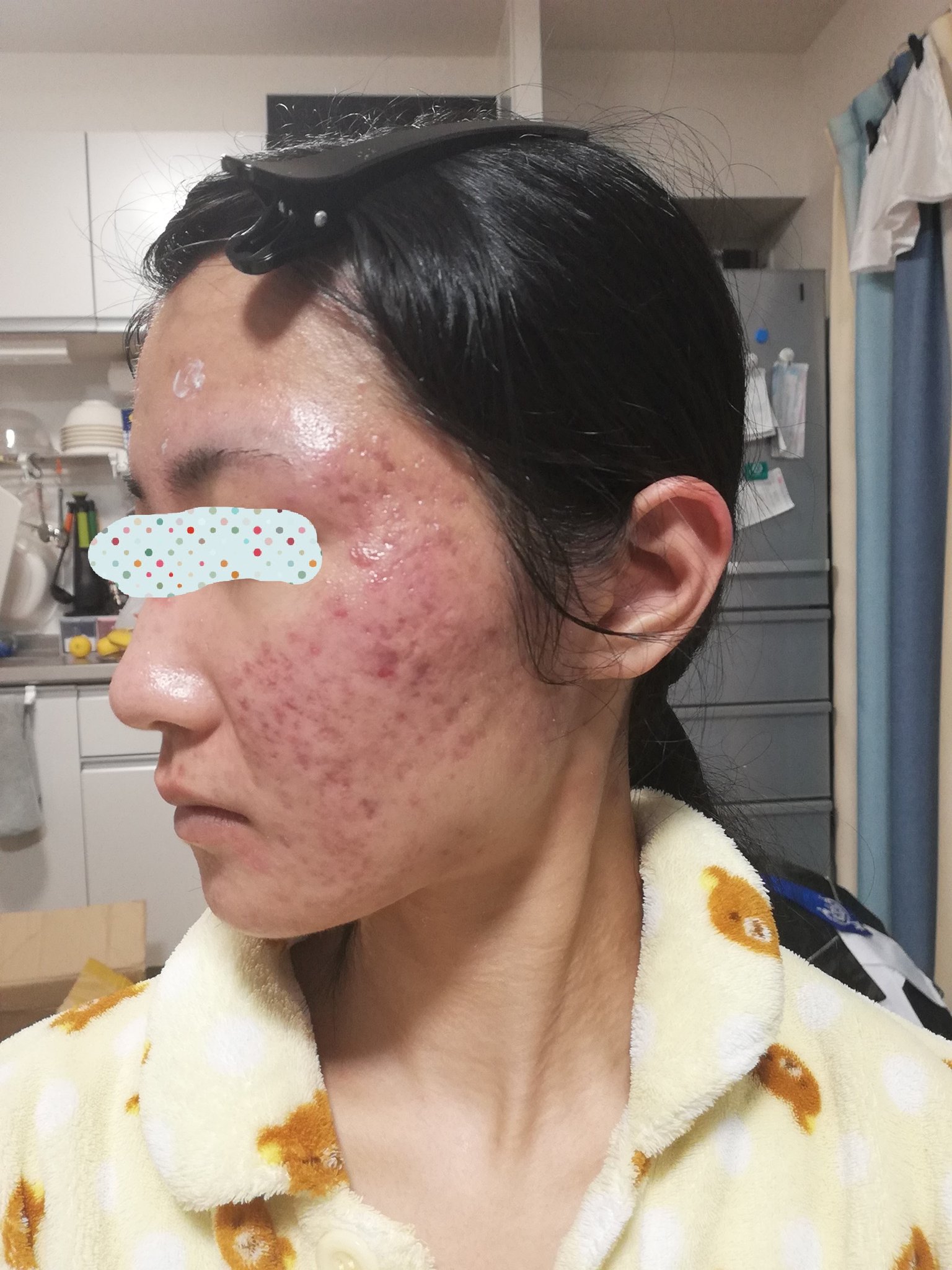 生貝 亀返信 拡散希望 私のコスプレを見てくれている人には引かれてしまうかもしれませんが 無加工の私の肌です ニキビ 肌荒れに悩んで辛い人や 相澤皮膚科の相澤先生の元までこのツイートが届けばいいなと思っています 相澤皮膚科 相澤