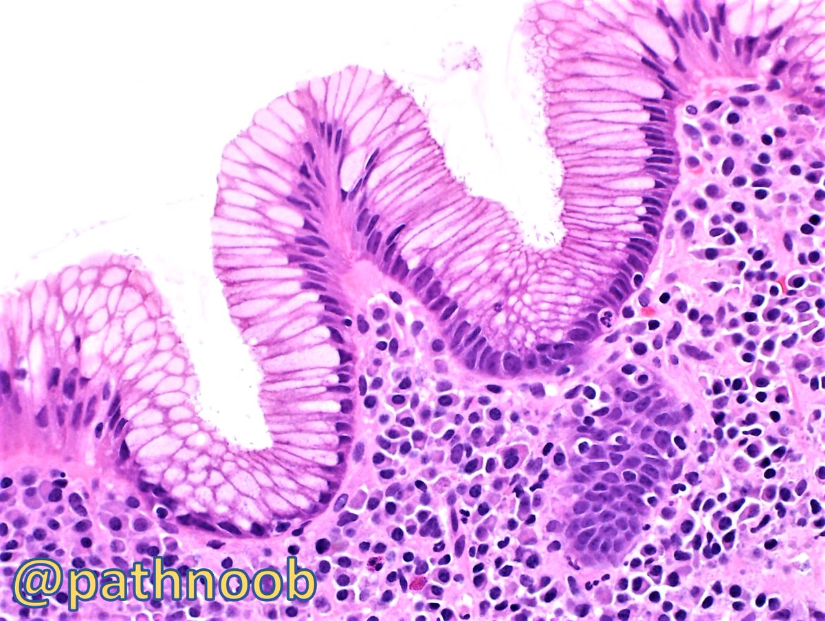 EToweryMD's tweet photo. Stomach, biopsy. A great educational case (especially for 'path noobs' like me)! #GIpath https://t.co/jRd4PoOAnK