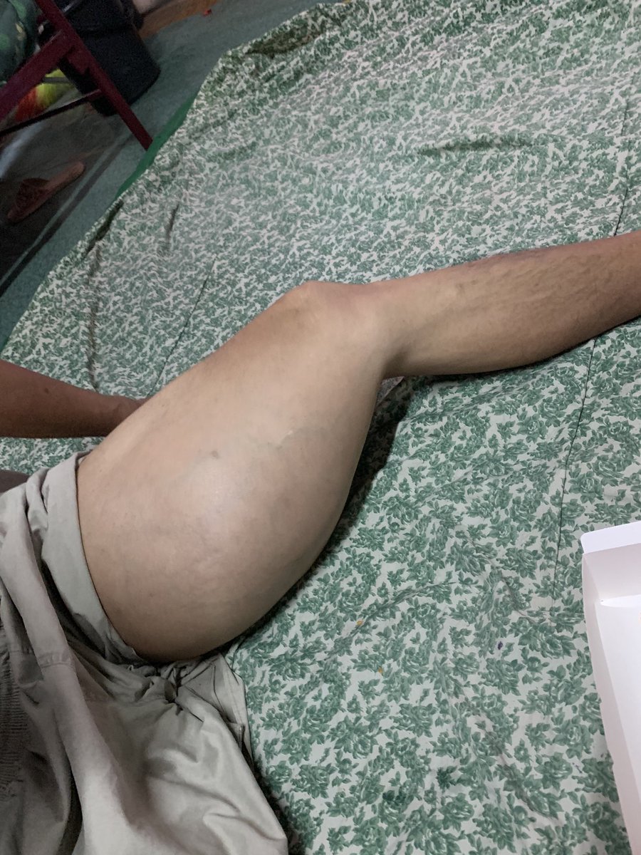 almunzir_'s tweet photo. Memerlukan dana sebanyak RM1500 untuk abg azhar menjalankan pemeriksaan penyakit kanser beliau . Sebelum ini abg azhar dah dipotong kaki kanan dia disebabkan penyakit ini jugak . Sekarang ni kaki kanan takde plus kaki kiri pulak kanser . https://t.co/niVM5aRt4J