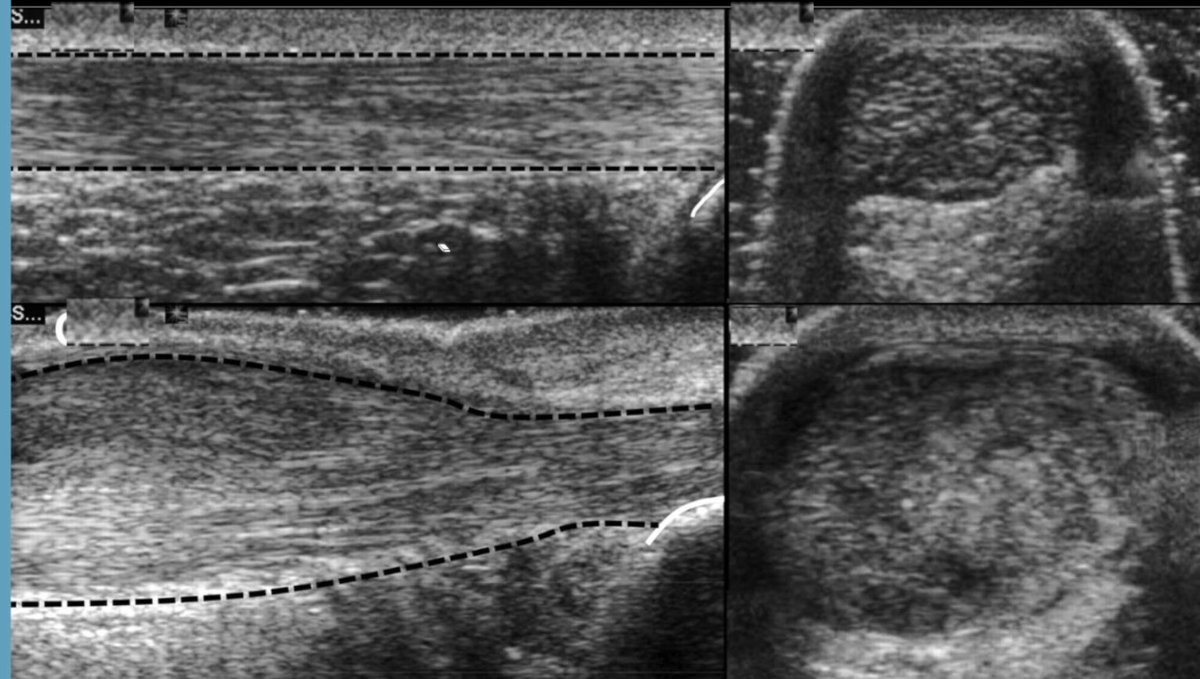 petef08's tweet image. Know the difference between tightness, stiffness, increased tone. #TriggerPoints #Performance