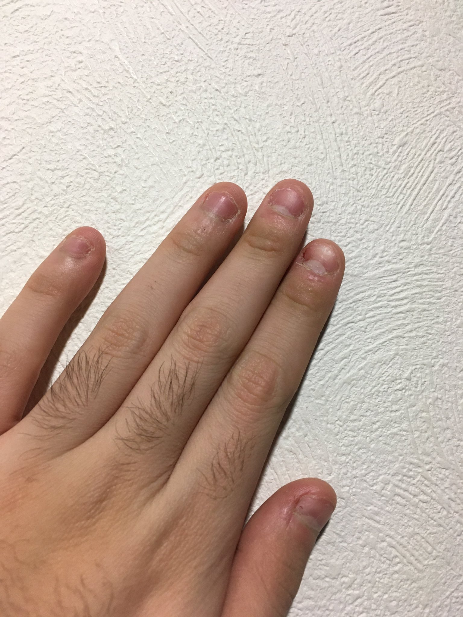 爪噛み克服アカ Skt6xwpto2x8jgm Twitter
