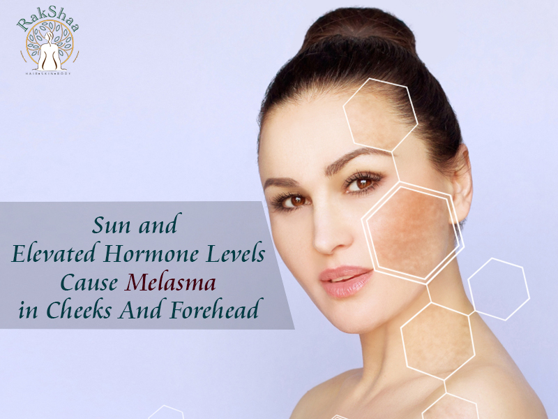 RakshaaSkin's tweet photo. Sun And Elevated Hormone Levels Cause Melasma In Cheeks And Forehead

#Sun #Level #HormoneLevels #Melasma #Cheeks #Forehead  #RakshaaSkinClinic #SkinClinic #SkinClinicInDelhi #Delhi #DermatologistInDelhi #DrRakeshJangra

https://t.co/sEctpzbIwK https://t.co/9G4bb5LiaD