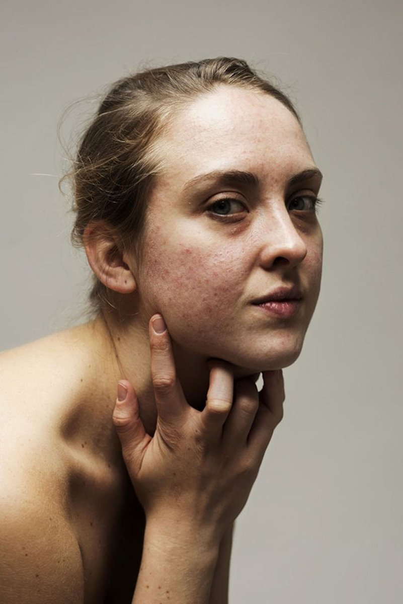 creapills's tweet photo. Ce projet photo sans maquillage célèbre les femmes naturelles et leurs problèmes de peau

Plus d'infos : https://t.co/7vzDl7Hub4 https://t.co/n9E7jTynMi