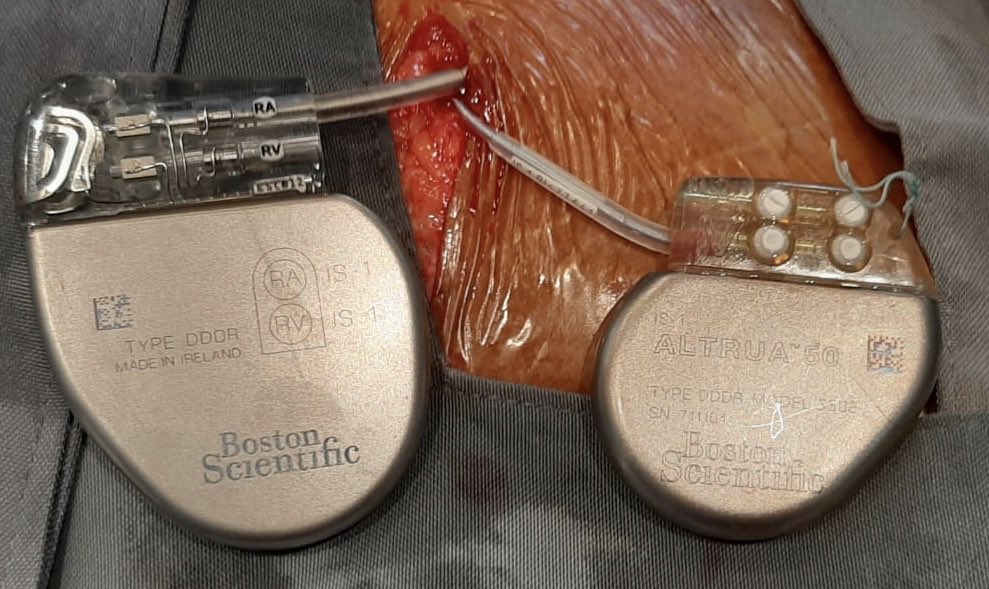 UlhasDr's tweet photo. Pacemakers not always become smaller. Battery-Achilles Heel @PacemakerPAG @pace_journal #cardiotwitter #cardiovascular #bradycardia #pacemakertherapy @SuchitMajumder @AparnaBalaji4 @BSCCardioAPAC @BSCCardiology @bostonsci @BIOTRONIK_US @MDT_Cardiac @Medtronic https://t.co/wesv8m8o2C