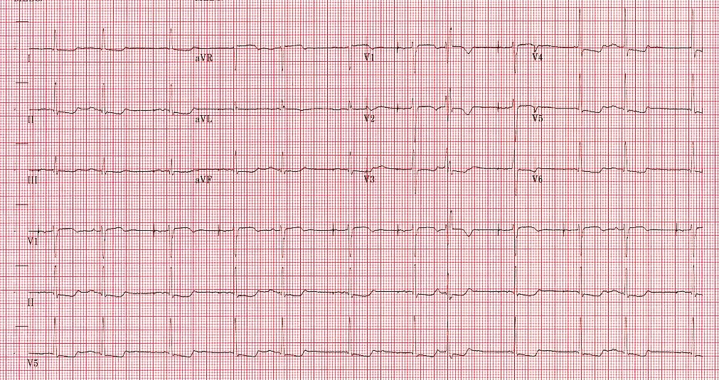 ACCinTouch's tweet photo. ICYMI: An 80-year-old male patient recently had a dual-chamber #epPPM placed for symptomatic sinus bradycardia. He was seem in clinic and had palpitations and chest pain. What does his #ECG show? https://t.co/DC4bO7zPru
 #ACCEd https://t.co/yV1PT7Xegc