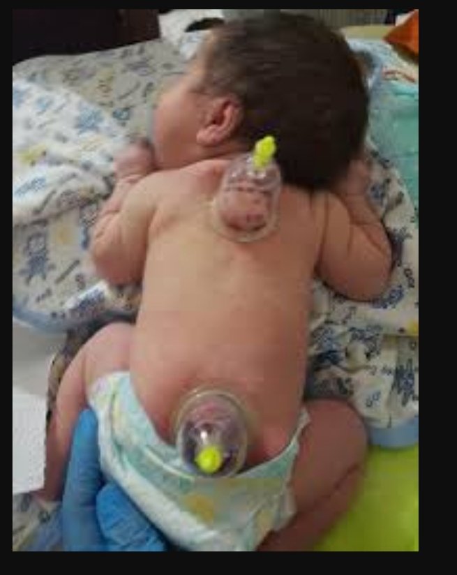 Sezeryan la doğan bebeklerin özellikle kuyruk sokumuna hacamat yapılması çokkk sağlıklıdır. Bezin olduğu yer. Belin alt kısmı