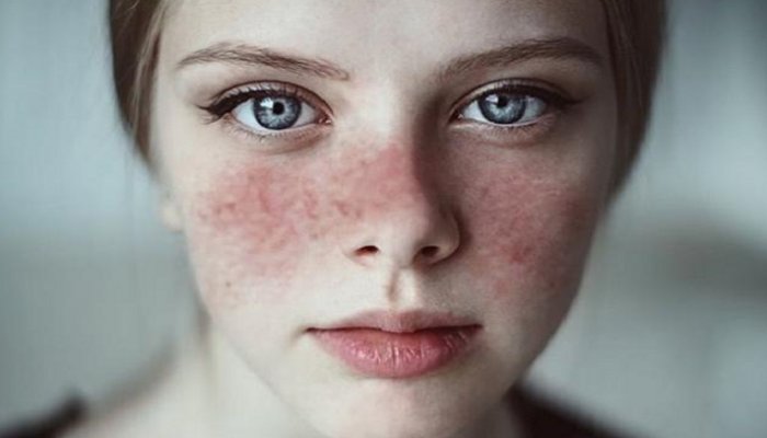 يعد مرض #الذئبه_الحمراء من الأمراض المناعية الذاتية المزمنة ويعتبر الجلد من أبرز الأعضاء التي يؤثر عليها المرض .
من الأعراض :
▫️حساسية مفرطة للضوء .
▫️تقرحات في الفم و الأنف . 
▫️طفح جلدي في أي مكان بالجسم .
▫️طفح جلدي على شكل فراشه في الوجه .